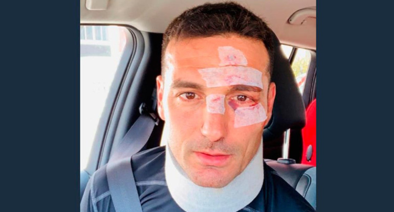 Lionel Scaloni tras accidente vial en Mallorca