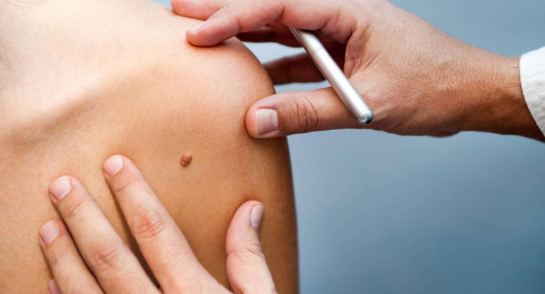 Melanoma, médico, salud, Foto iStock