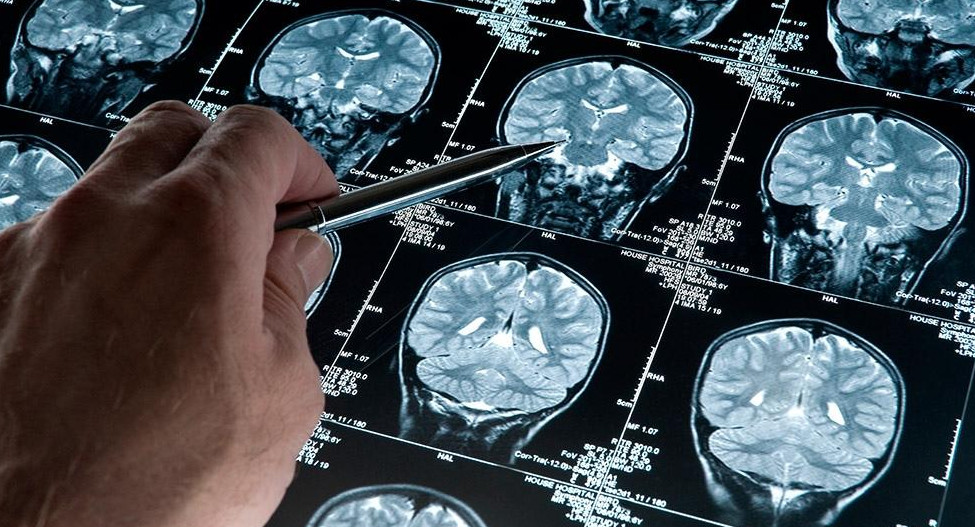 Alzheimer, estudios médicos