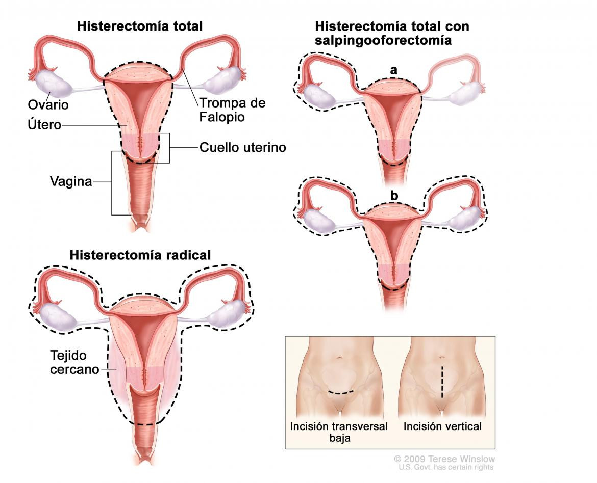 histerectomía completa