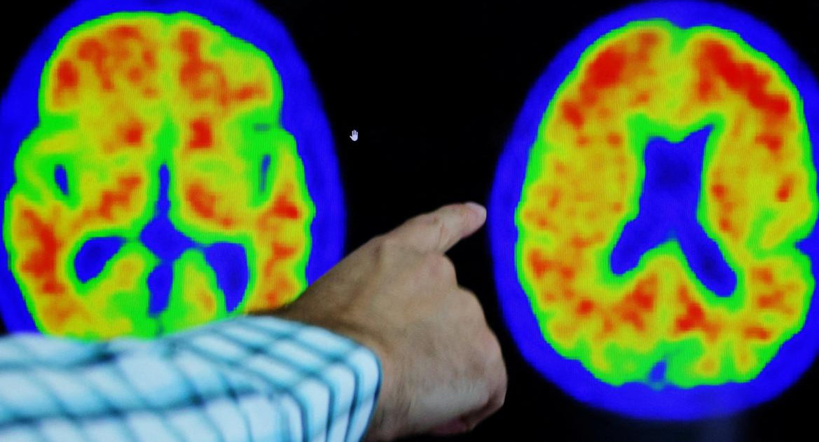 Alzheimer, salud. Foto: Reuters