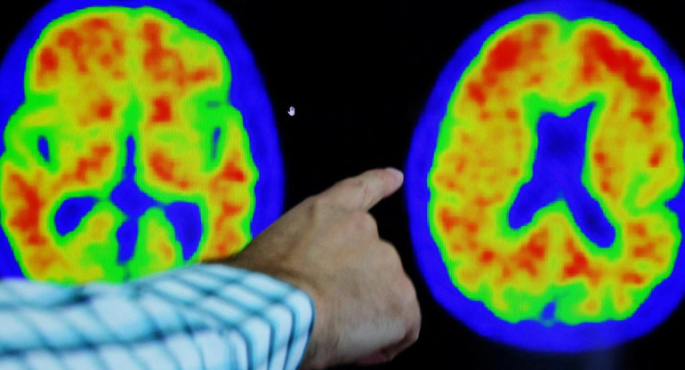 Alzheimer, salud. Foto: Reuters