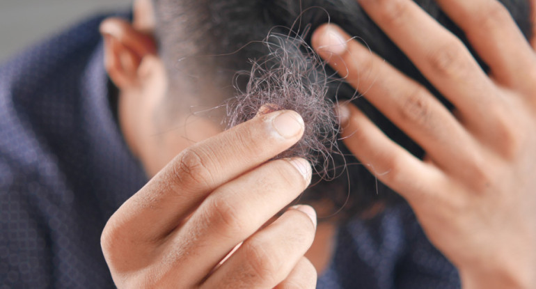 Caída de pelo, alopecia. Foto: Unsplash