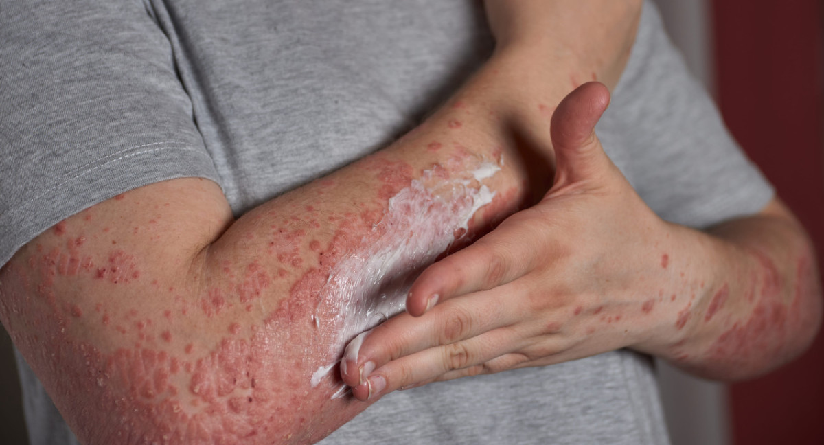 Urticaria por estrés. Foto: Freepik.