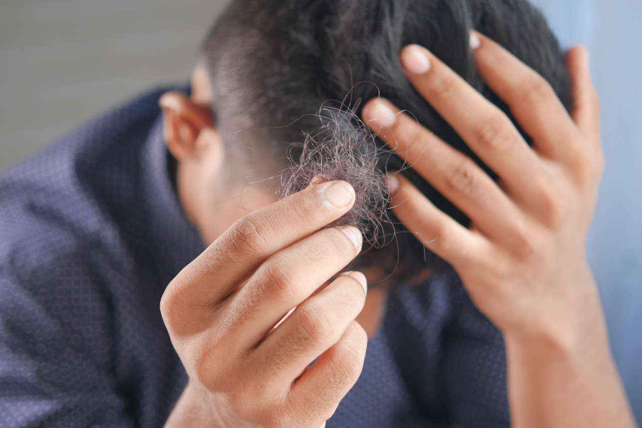 Alopecia, caída de cabello. Foto Unsplash.