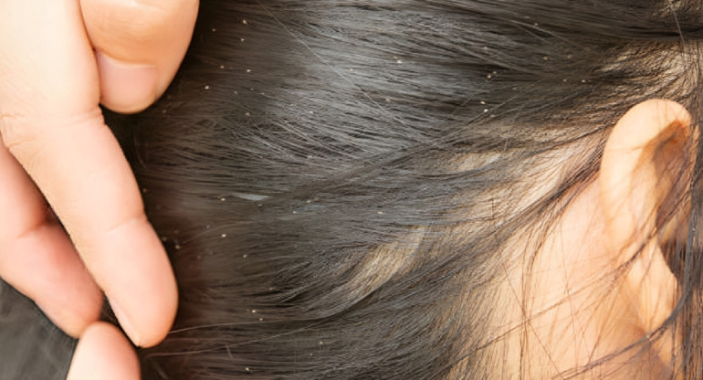 Cabello con caspa. Foto: Unsplash.