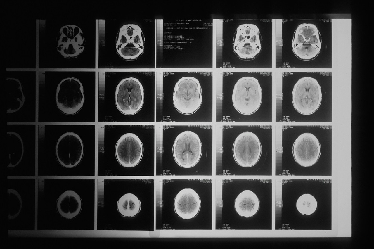 Medicina, tumor cerebral. Foto: Unsplash.