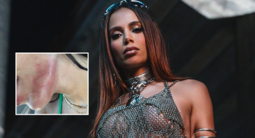 Anitta sufrió quemaduras en su cuerpo por una medusa.