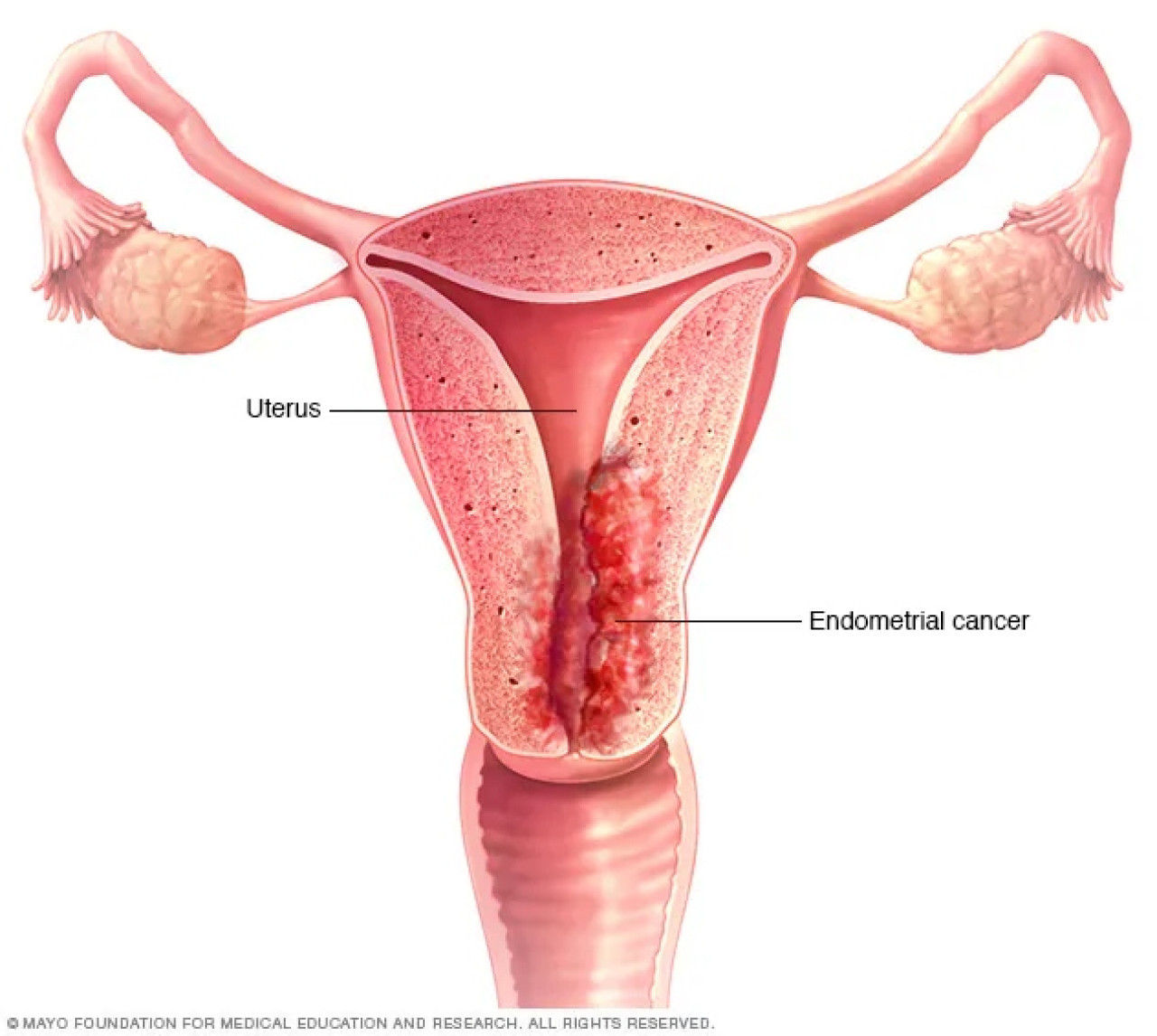 Cáncer de endometrio. Fuente:  Mayo Clinic