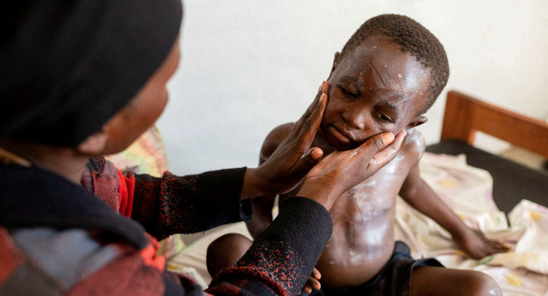 Mpox virus; viruela del mono. Foto: Reuters.