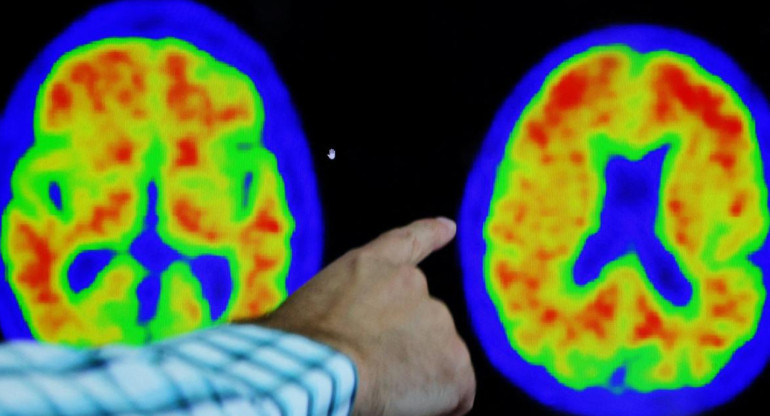 Alzheimer, salud. Foto: Reuters.