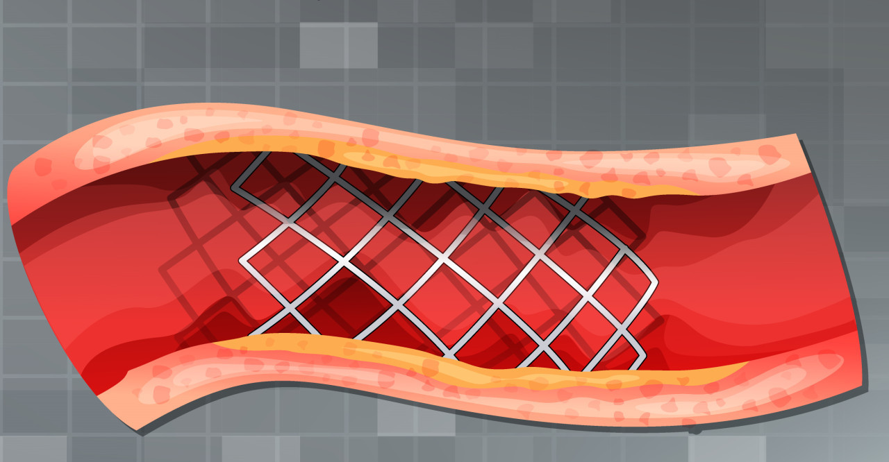 Colocación de stent. Foto: Freepik